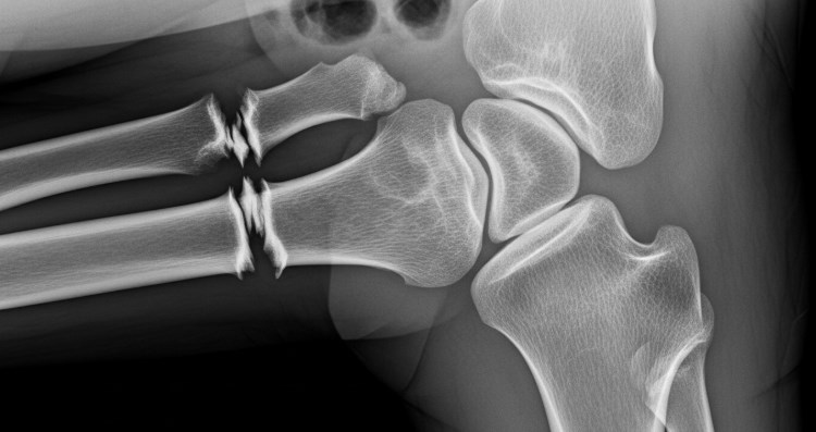 삼성생명 골절 진단비 청구서류 총정리 2025년 최신 정보 및 빠른 신청 방법 27