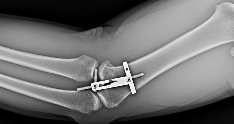 삼성생명 골절 진단비 청구서류 총정리 2025년 최신 정보 및 빠른 신청 방법 29